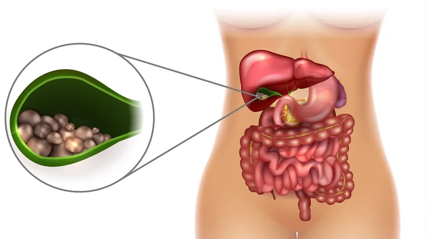 Porselen Safra Kesesi: Ciddi Durum, Belirtileri ve Ameliyatın Önemi Vurgulandı