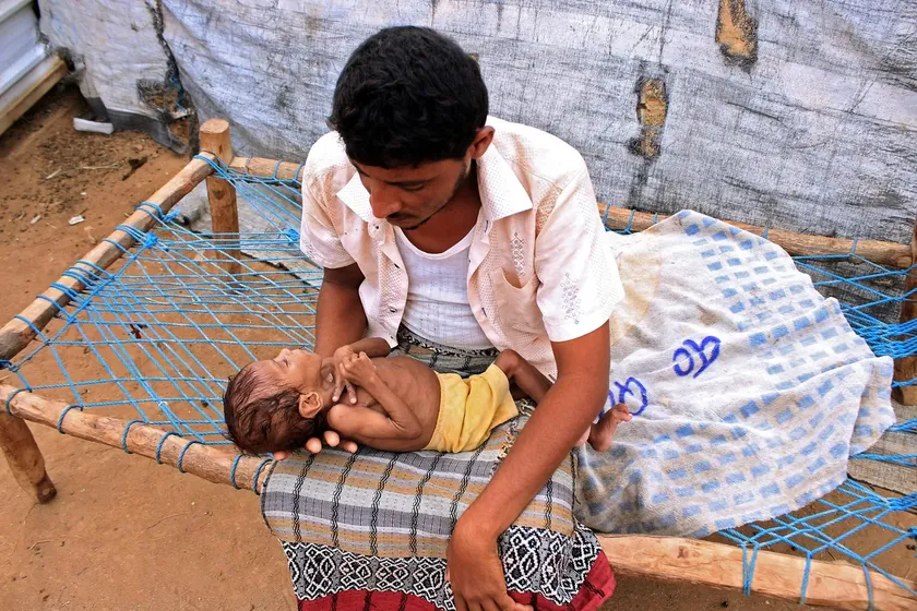 UNICEF Yemen'deki Çocuklarda Açlık Oranı Artıyor