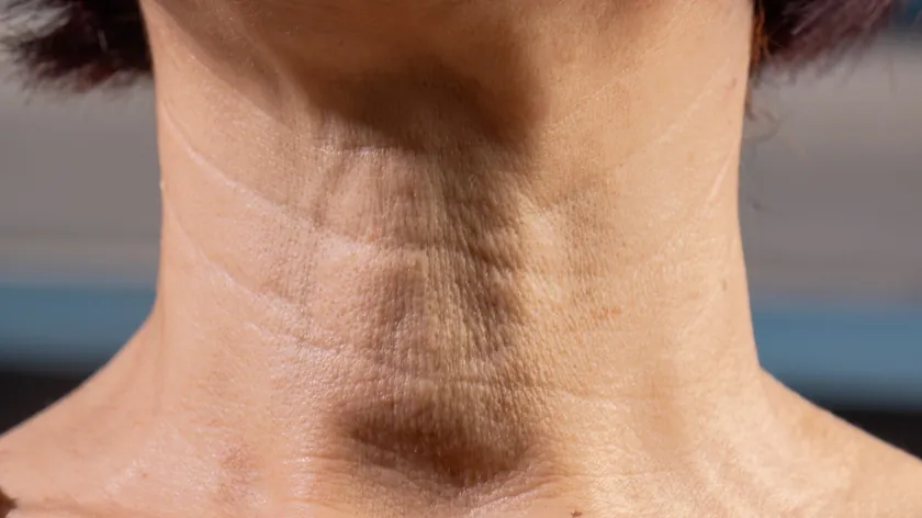 Boyundaki Sarkmaların Nedenleri ve Tedavi Yöntemleri Uzmanlar Tarafından Açıklandı