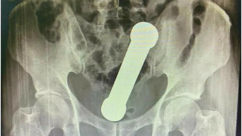 Brezilya'da 54 yaşındaki adamın rektumundan 2 kilogramlık dambıl çıkarıldı