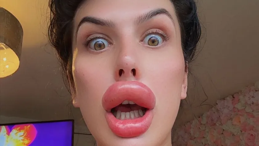 Sofija Lips, dudaklarını dolgularla doldurmuştur.