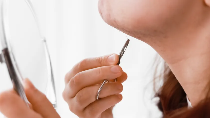 Višak muşkih hormonu (androgen) kadınlarda Belirtiler, nedenler ve tedavi