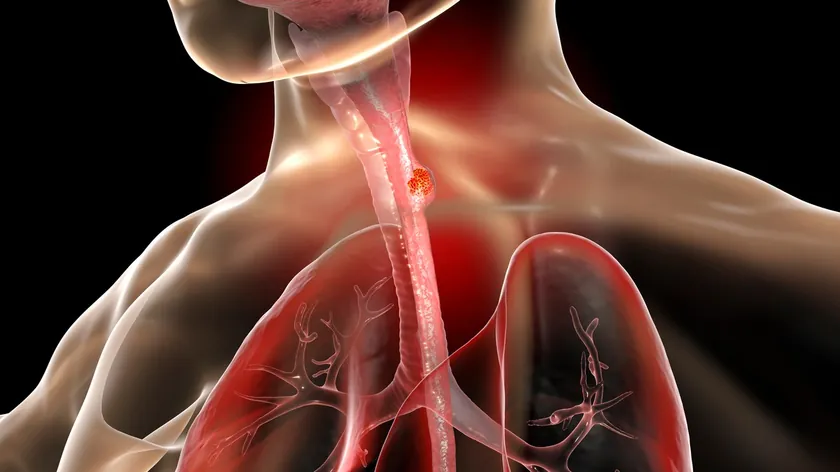 Barrett Özofagusu Yemek Borusu Kanseri Gelişimi İçin Temeldir Görünmez Olsa Bile
