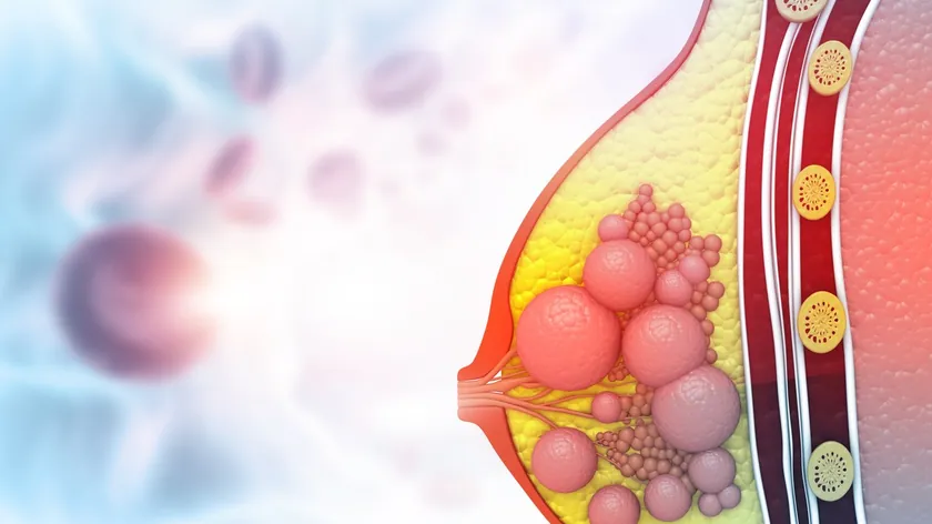 Duktal Karsinom In Situ: Erken Evre Meme Kanseri Durumunu İhmal Etmeyin