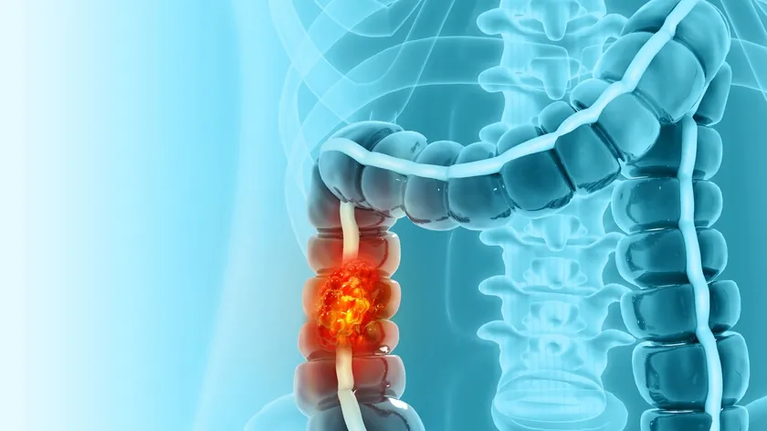 Sırbistan Rektum İltihabı Proktit Nedenleri Belirtileri Tedavi Yaklaşımları Açıklandı