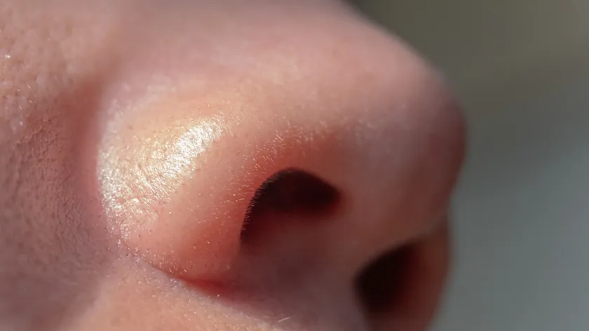 Burunda Kötü Koku Neden Olur ve Nasıl Tedavi Edilir Bilimsel Açıklamalar