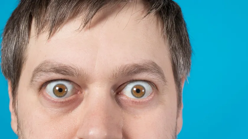 Gözlerin Öne Çıkması Proptoz Nedir Belirtileri Tedavisi ve Oluşturduğu Riskler Aktarıldı