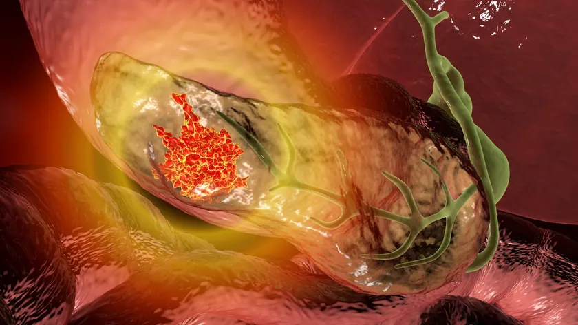 Pankreas Kanseri Sinsi ve Ölümcül Bir Hastalık Erken Teşhis Hayati Önem Taşıyor