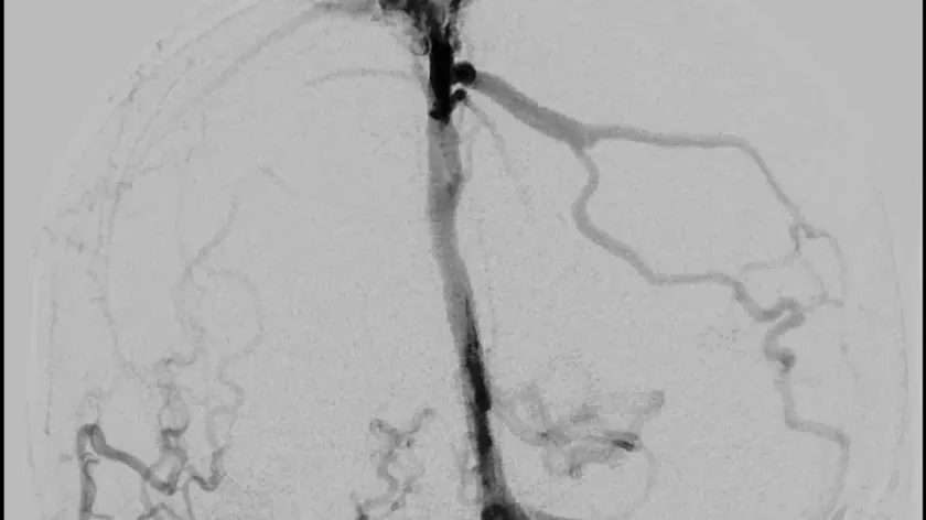 Sırbistan'da ilk kez beyin ven stent uygulanması