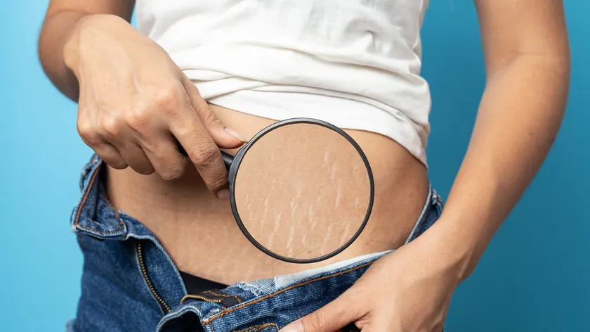 Ciltteki Çatlakların (Stria) Oluşumu, Nedenleri ve Giderme Yöntemleri Hakkında Bilgiler Aktarıldı