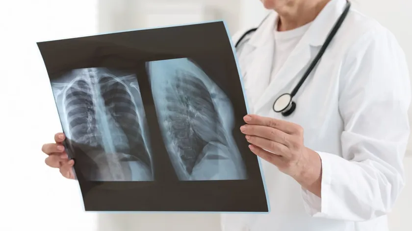 Akciğer Kanseri Hastalarında Yüksek Kan Pıhtısı Riski Uyarısı Yapıldı