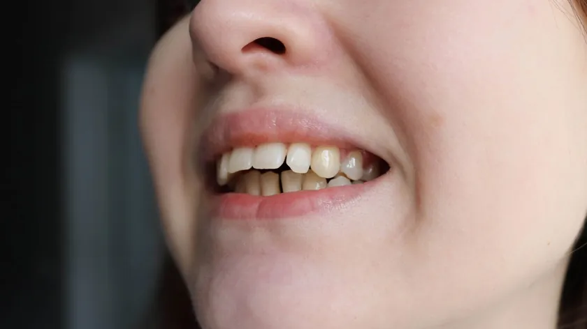 Yanlış Çene Kapanışı Maloklüzyon Belirtileri Nedenleri Etkili Tedavi Yöntemleri Açıklandı