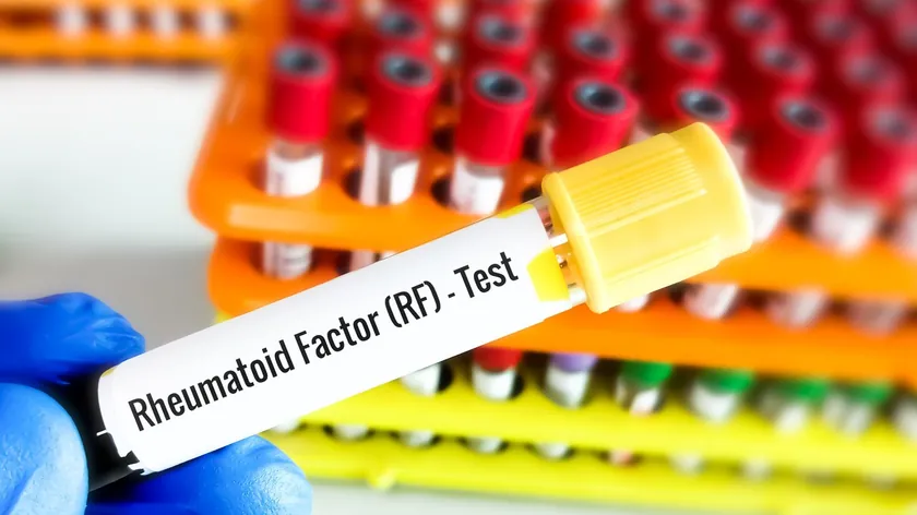 Romatoid Faktör Yüksekliği Sağlıklı Dokulara Zarar Verebilir Uzmanlar Açıklama Yaptı