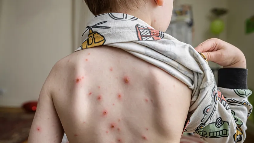 Viral döküntü nasıl tanınır, yayılması önlenir ve belirtileri hafifletilir