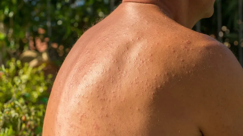 Güneş Kremi Alerjileri: Nadir de Olsa Ciddi Cilt Reaksiyonları Gelişebilir