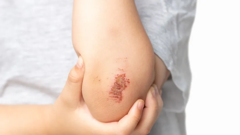 Yara Kabukları: Oluşumu, İyileşme Süreci ve Dikkat Edilmesi Gerekenler Ayrıntılarıyla Açıklandı