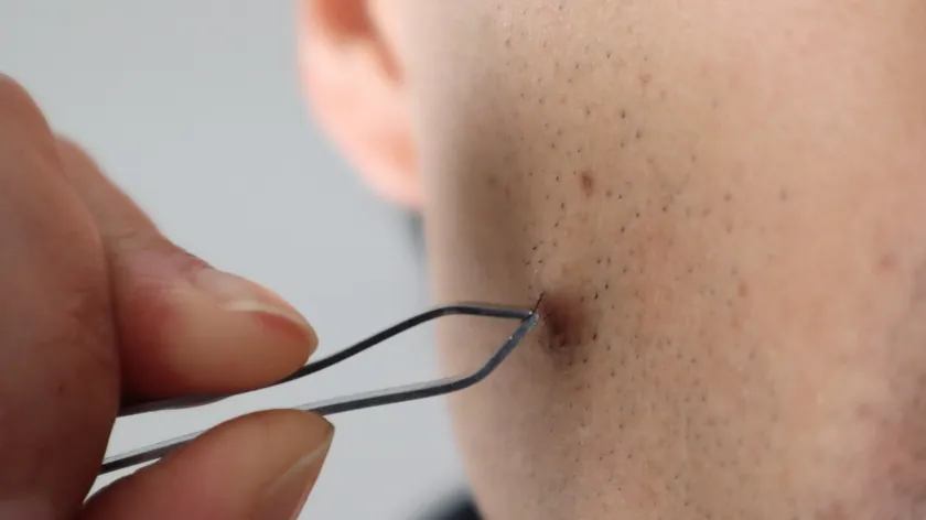 Batık Kıl Nedir Nasıl Oluşur Sivilceden Nasıl Ayırt Edilir Uzmanlar Açıkladı