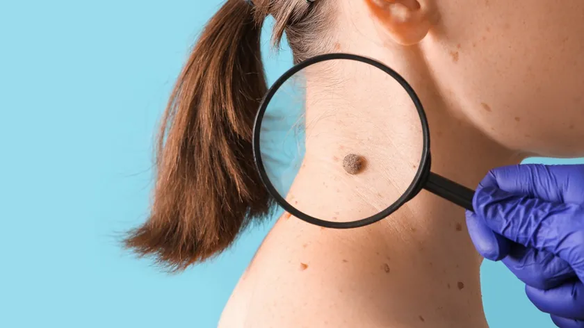 Sırbistan: Benlerdeki 'Çirkin Ördek Yavruları' Malign Melanom İçin Erken İşaret