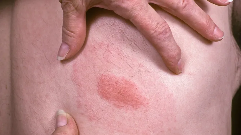 Sırbistan Kene Nimf Tehlikesi Yayılıyor Tanınma ve Korunma Yöntemleri Açıklandı