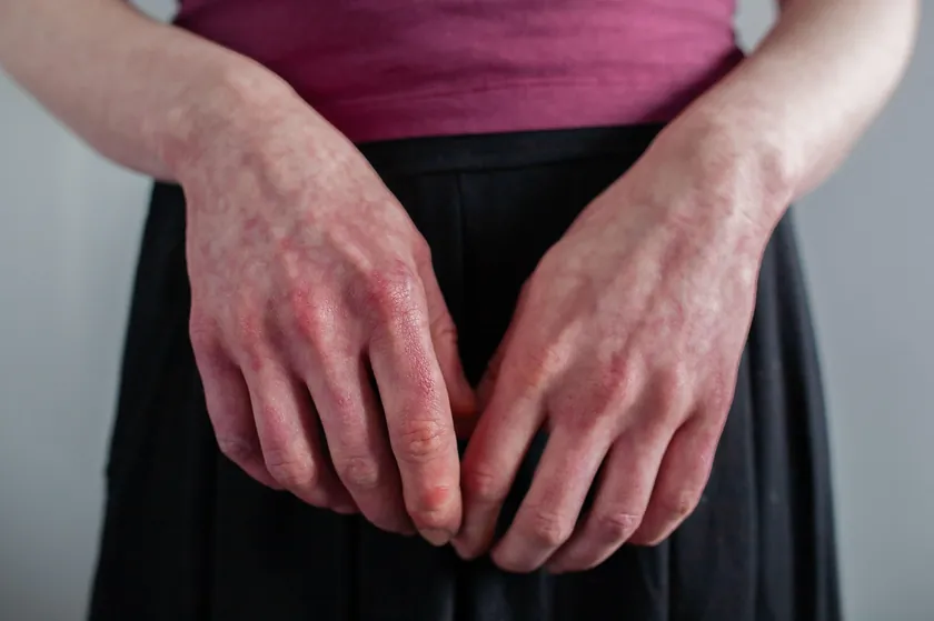 Neobičan cilt işareti kardiyovasküler sorunlara yol açabilir