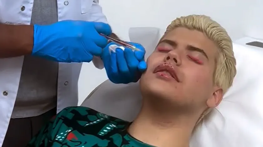Elite 10 öncesi Uroš Stanić dudak ve bikinilerini büyütmüş