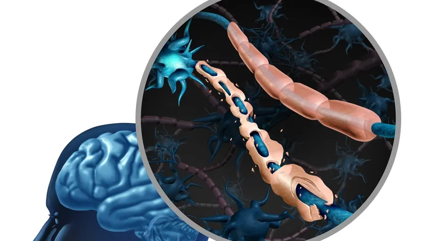 İngiltere'de Multipl Skleroz hastalarının ölüm riskini artıran üç faktör saptandı