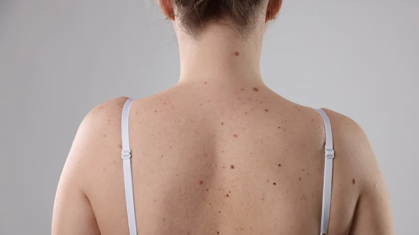 Ciltteki ben sayısının genetik, güneşe maruz kalma ve hormonal değişimlerle bağlantısı