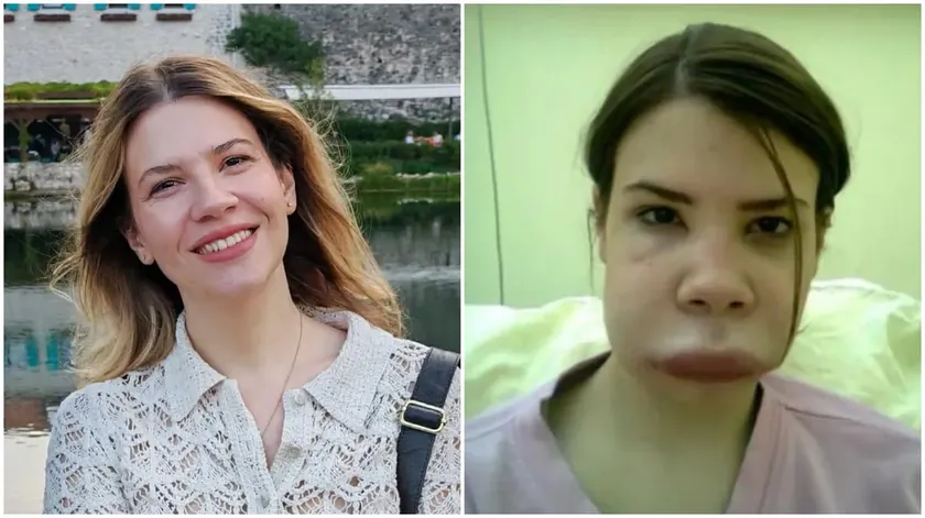 Jovana 20 yıl alerji sanmış, sonra nadir bir sendrom nedeniyle kontrolsüz şişmelere sahip olduğunu fark etti.