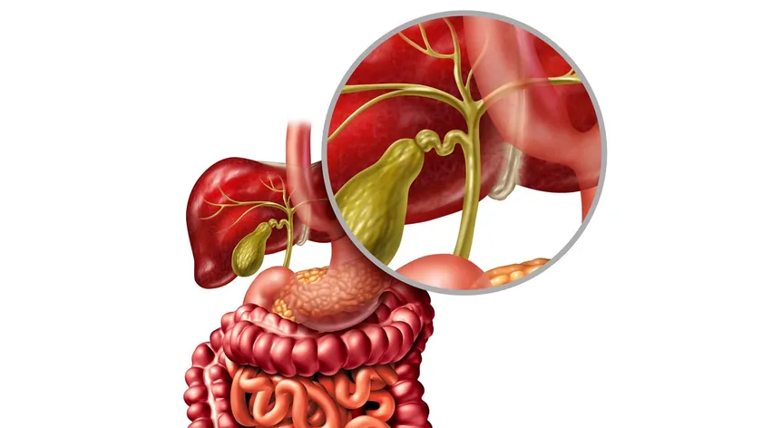 Safra Yolu Darlığı: Nedenleri, Belirtileri ve Tedavi Yöntemleri Hakkında Önemli Bilgiler