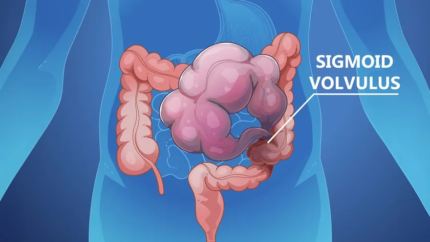 Şiddetli Karın Ağrısı ve Gaz Volvulus Belirtisi Olabilir Hayati Risk Taşıyor
