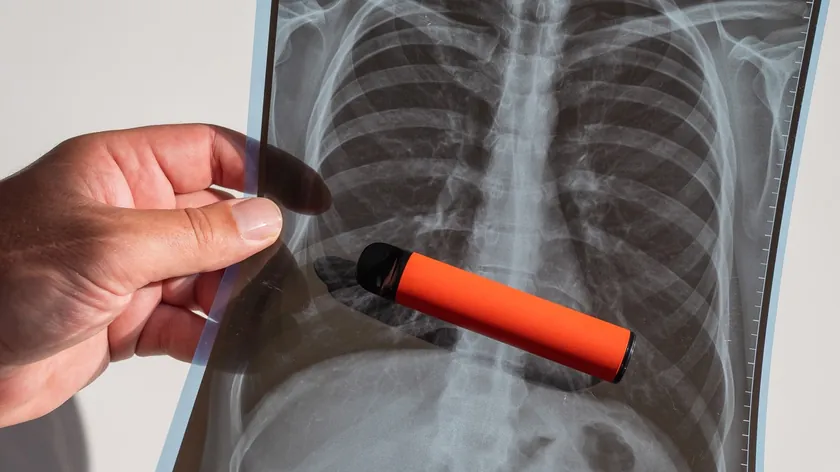 Rusya'daki uzmanlar patlamış mısır akciğeri hastalığında yeni klinik bulgular açıkladı