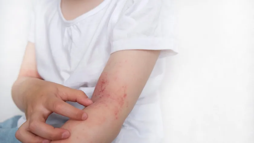 Atopijski dermatit dünya genelinde 230 milyondan fazla insanı etkiliyor.