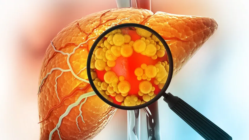 Metabolik Karaciğer Hastalığı 2050 Yılına Kadar 2 Milyar İnsanı Etkileyecek