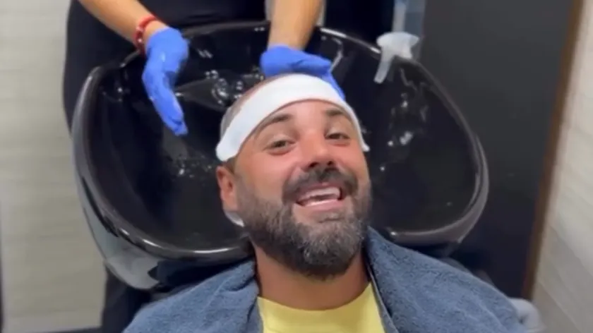 Rijaliti yarışmacısı Luka Vujović'in saç ekim operasyonundan sonra eşi Anita Stanojlović'in ona yardımcı olduğunu gösterdi.