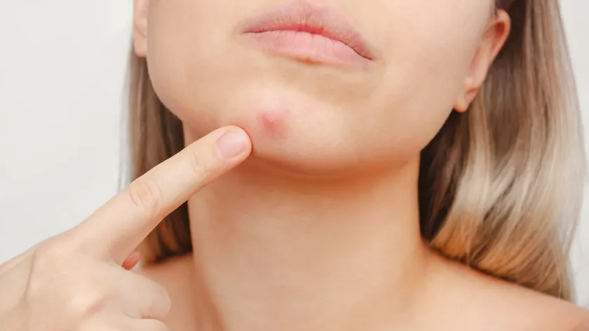 Yüzdeki Akne Bölgeleri İçsel Sağlık Sinyalleri Veriyor Uzmanlar Yerleşimin Önemini Vurguladı