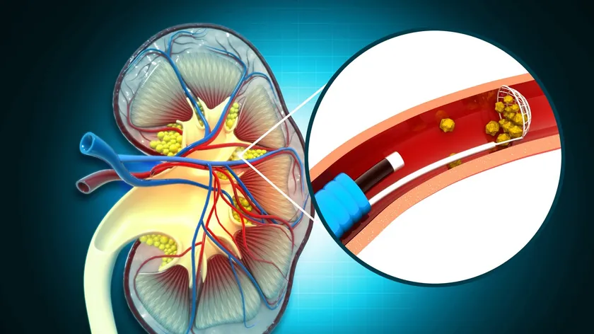 Doktorlar Böbrek Taşı Oluşumunu Önlemenin Yollarını Detaylı Şekilde Açıkladı