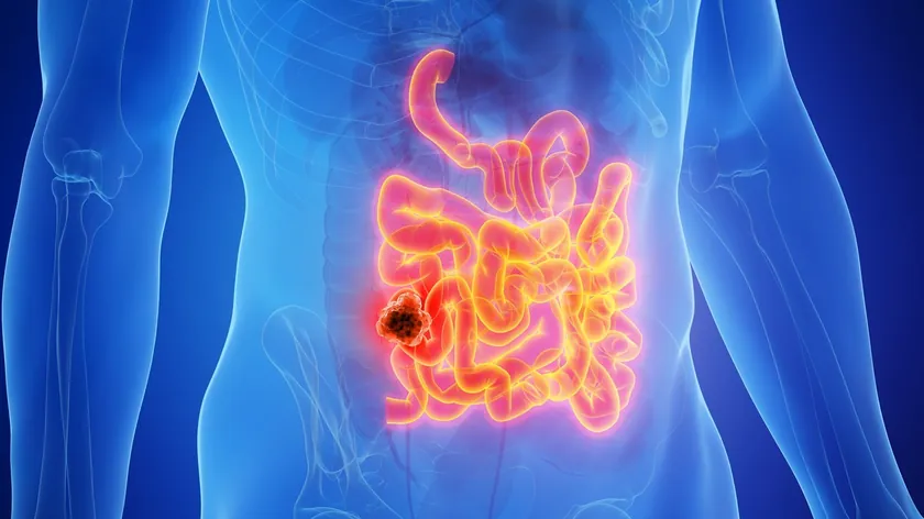 Kısa Bağırsak Sendromu Nedir? Nedenleri, Belirtileri ve Hayati Risk Taşıyan Komplikasyonları Açıklandı