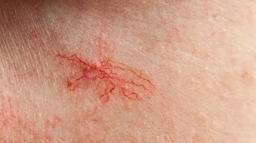 Yüzdeki örümcek damarların nedenleri, yayılmasını önleme ve tedavi yolları